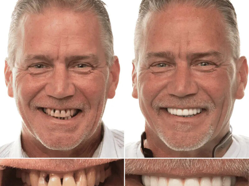 ATL Dental Implants
