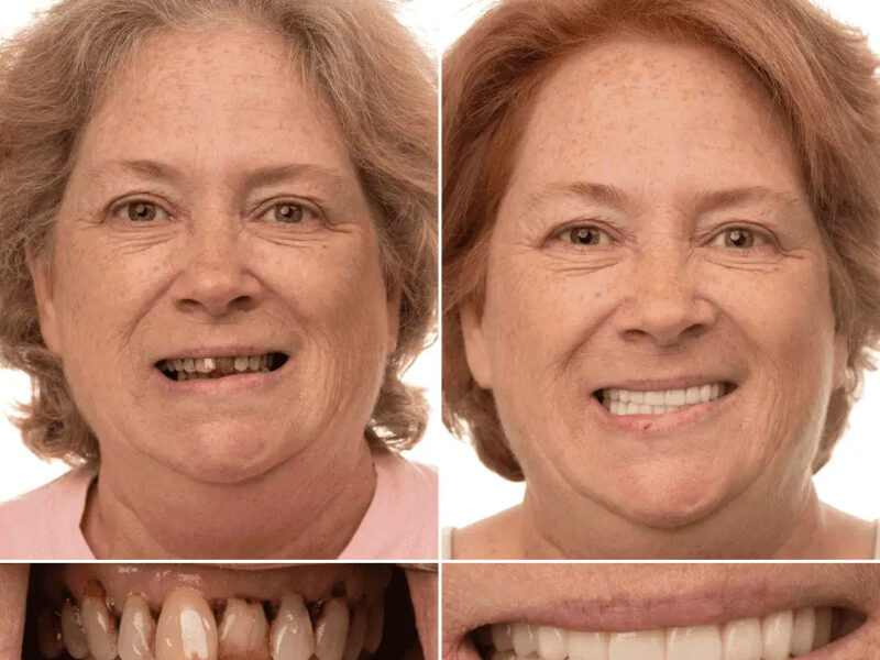 ATL Dental Implants