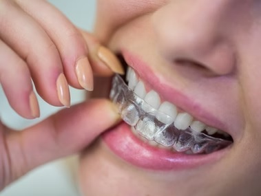 Bracecare Dental - Best Dental Clinic in Manikonda | Invisalign & Braces Hyderabad